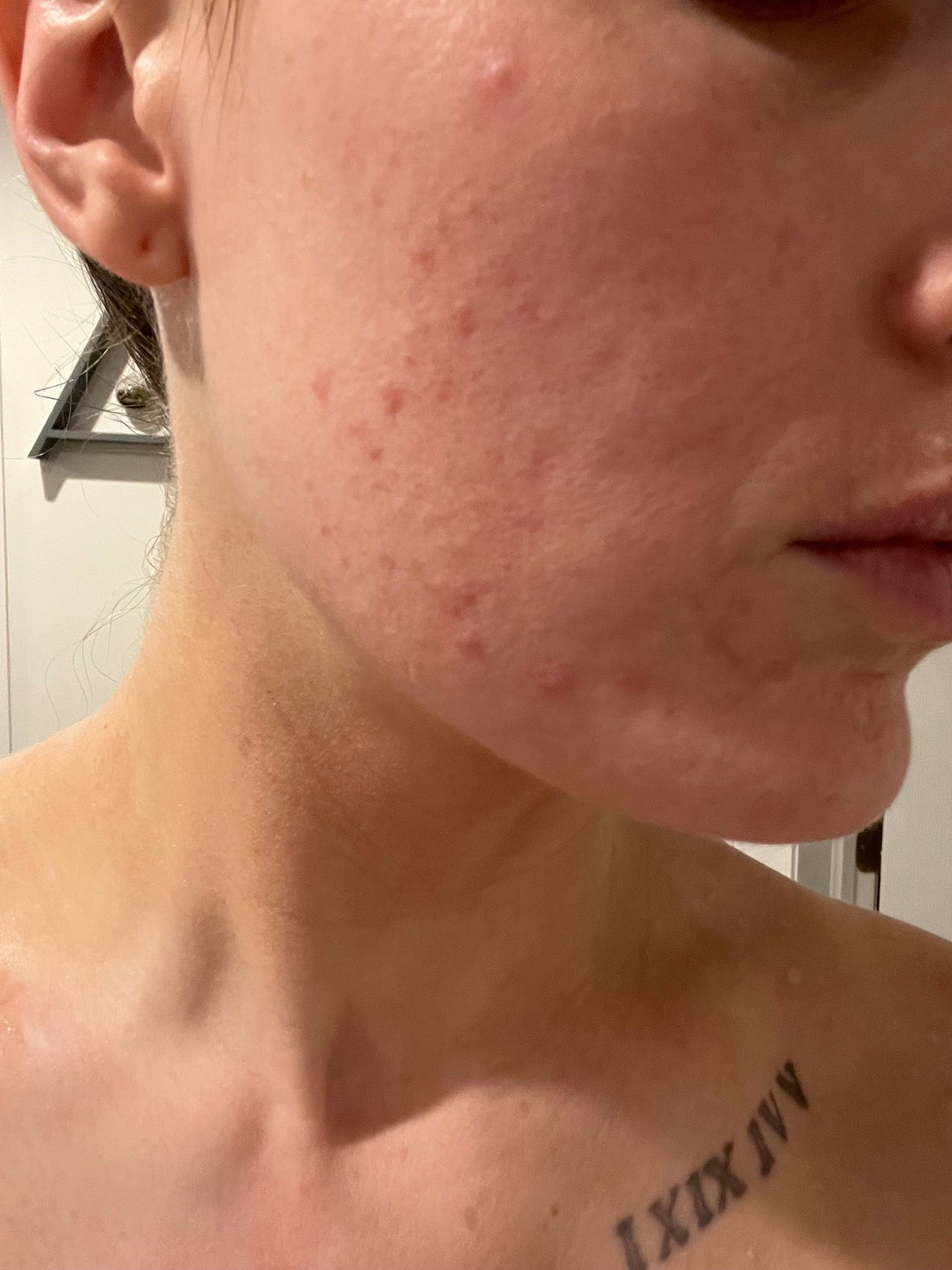 My Decade Long Acne Journey- Started From the Bottom Now We Here